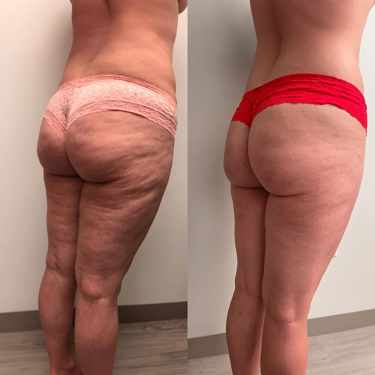 SCULVERA® PRO Body RF Device