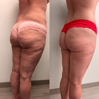 SCULVERA® PRO Body RF Device